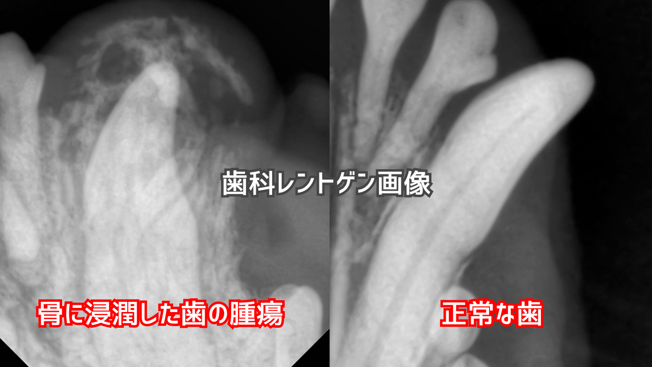 歯科レントゲンの比較写真。左は骨増生を伴う腫瘍、右は正常な歯の写真。