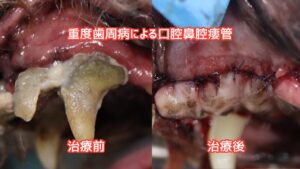 口腔鼻腔瘻