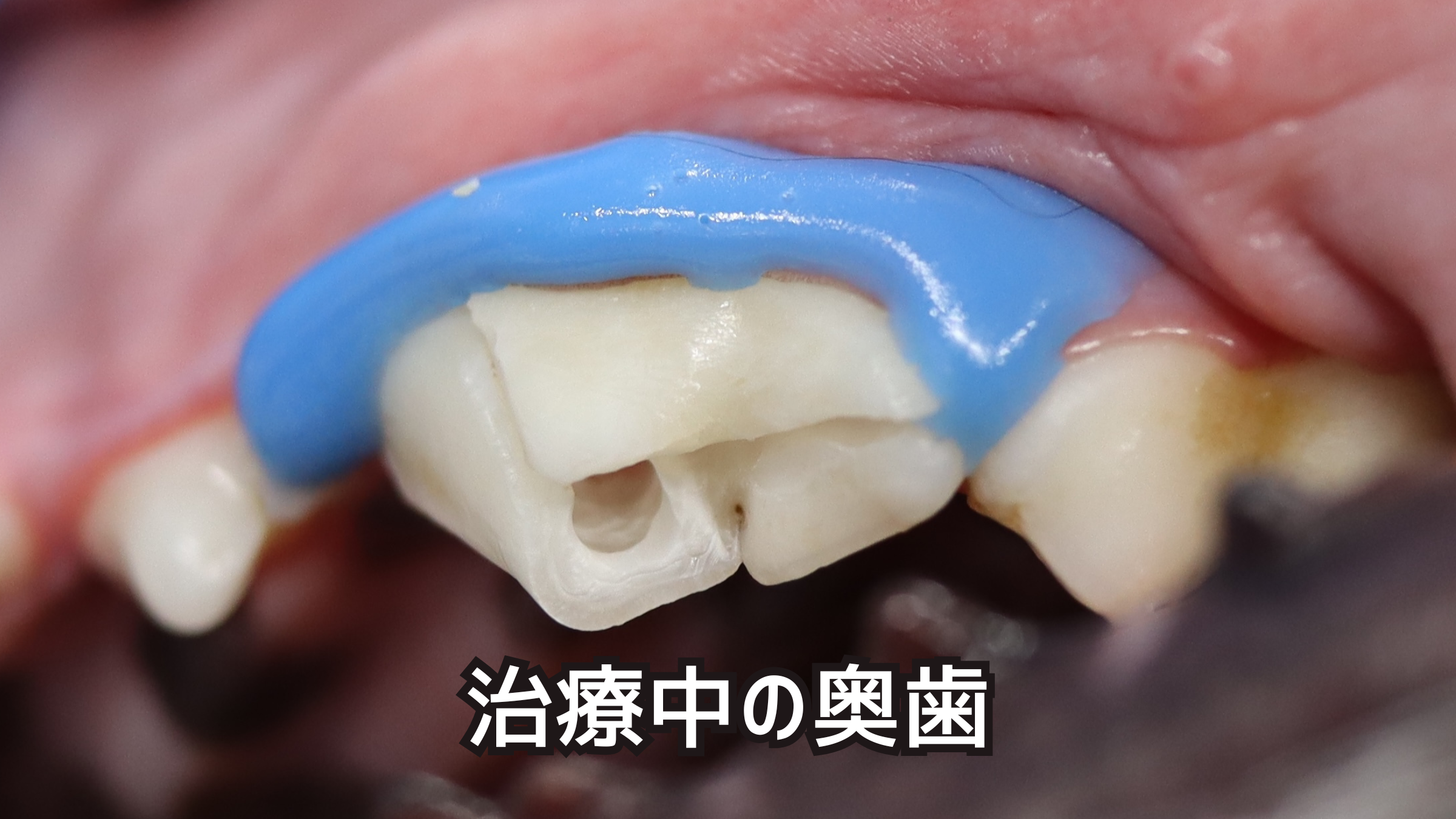 治療中の奥歯の写真。神経を温存する生活歯髄切断を行った。