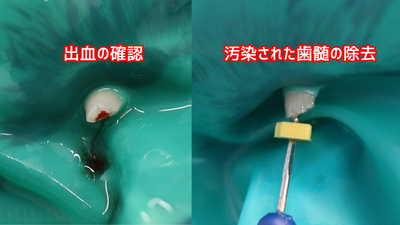 破折歯に対する根管治療の画像