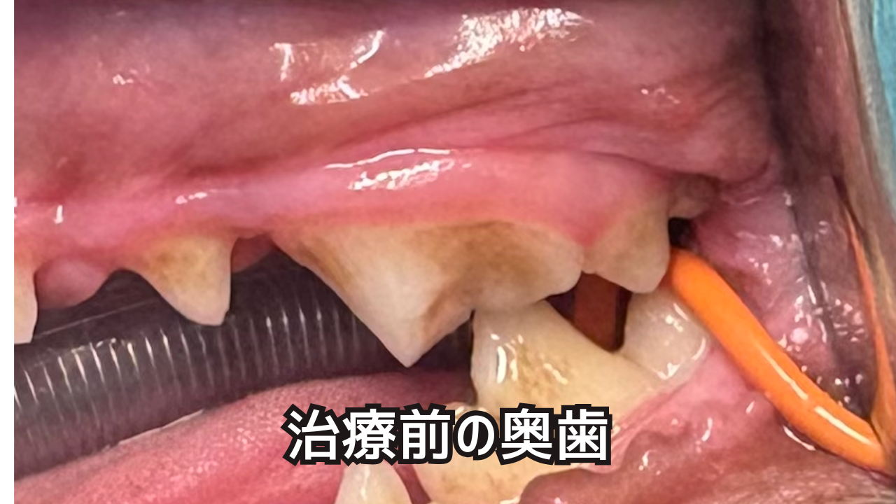 治療前の折れてしまった奥歯。歯髄が露出している。