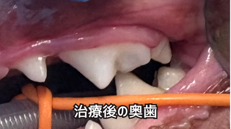 治療を行なった奥歯の写真
