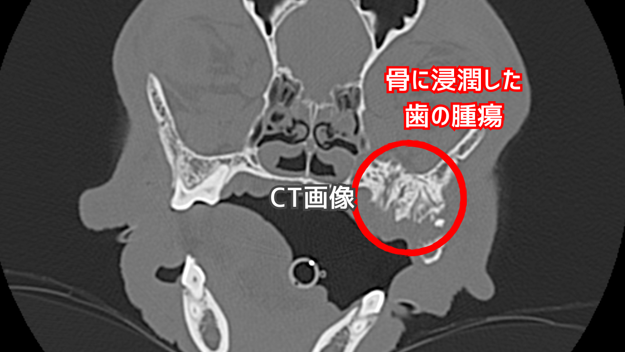 骨に浸潤した歯の腫瘍のCT画像