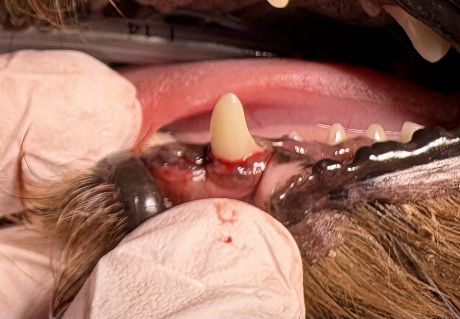 治療後の歯。前歯を抜歯している。