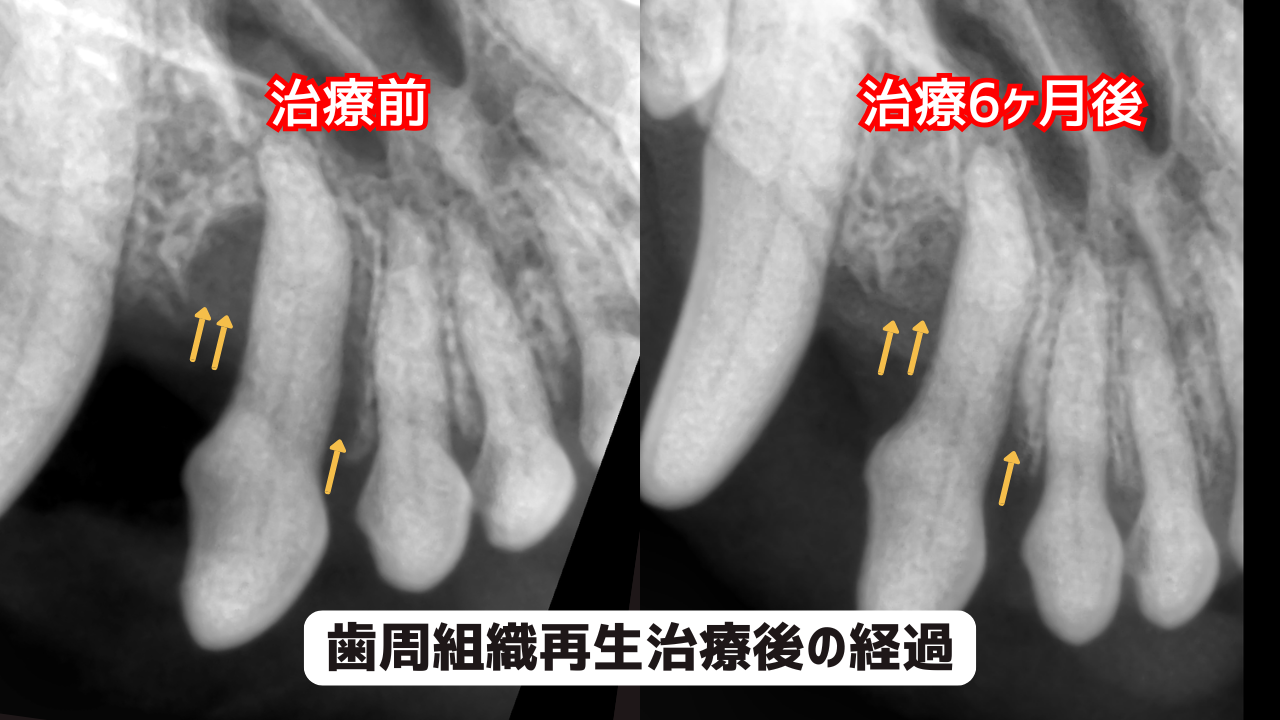 歯周組織再生治療前後の歯科レントゲン写真。