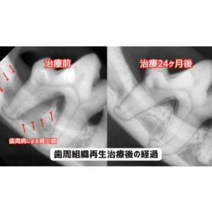 歯周組織再生治療の経過
