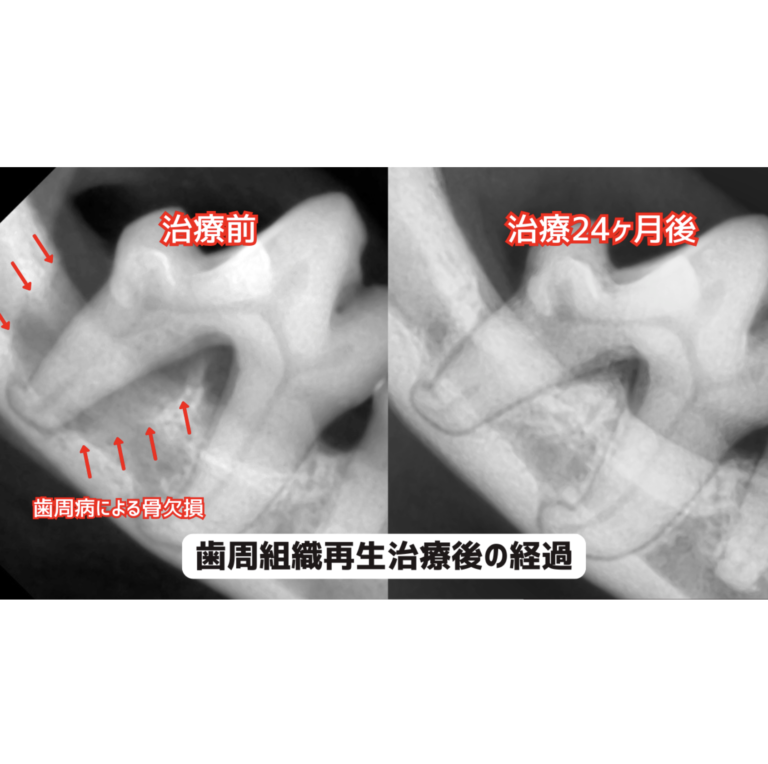 歯周組織再生治療の経過