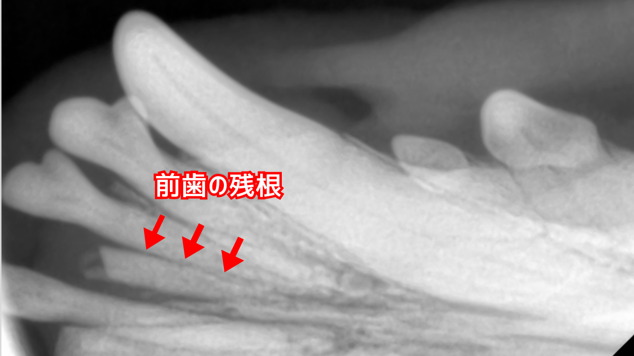 前歯のレントゲン写真。前歯の残根を認める。