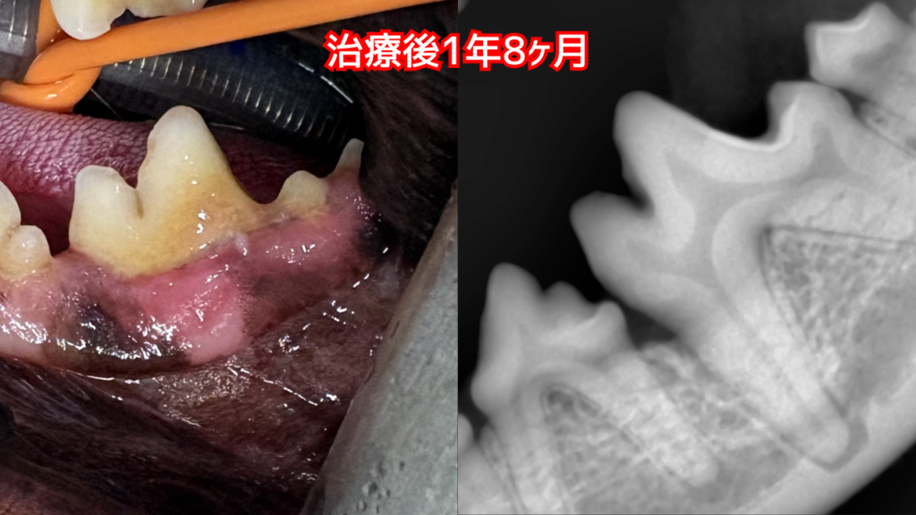治療1年8ヶ月後の症例の口腔写真。硬組織が再生している。