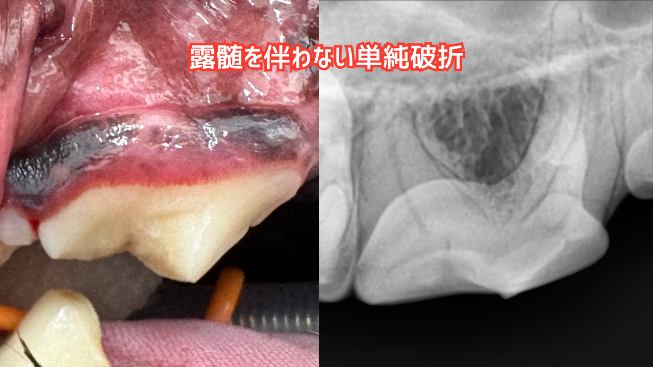 破折歯のレントゲン写真