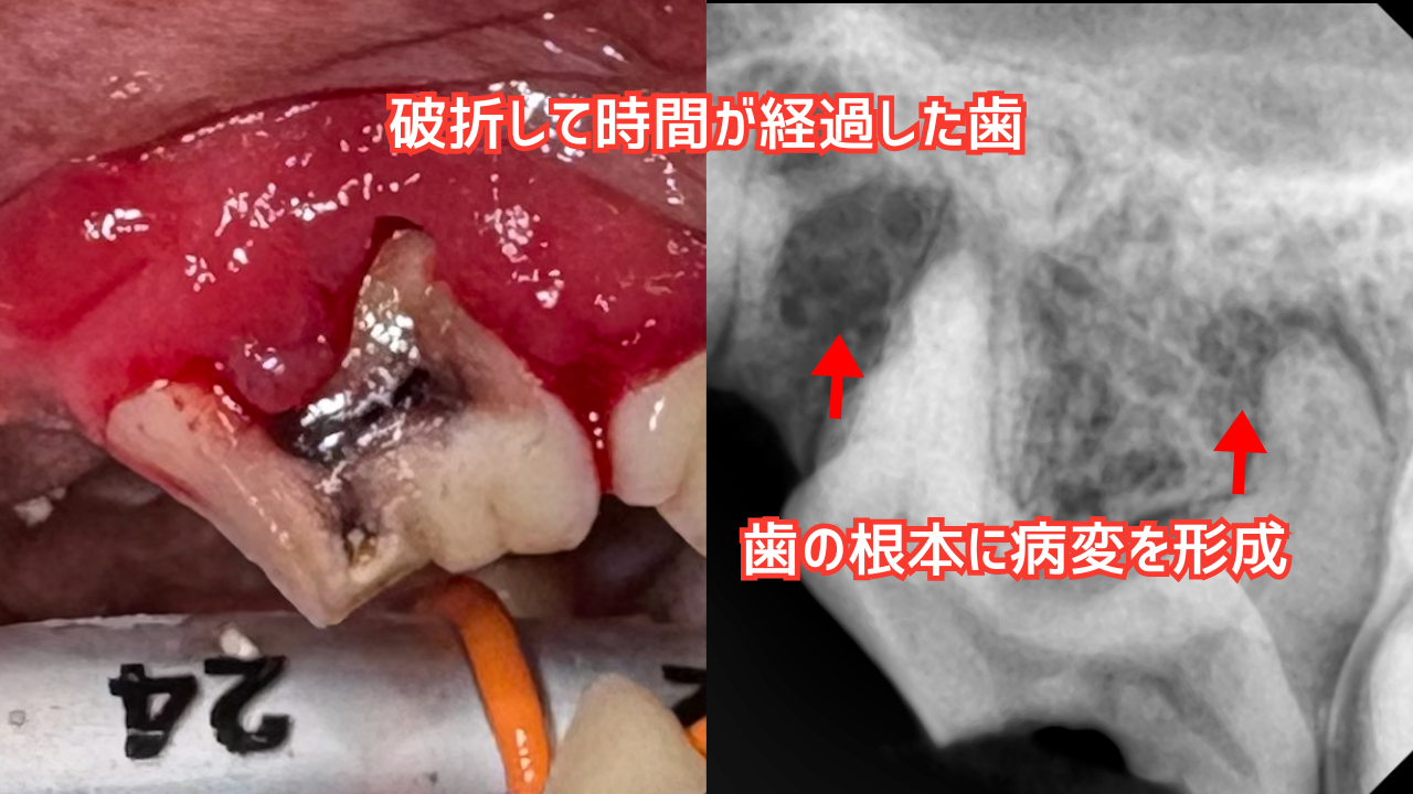 折れた歯を放置するリスク