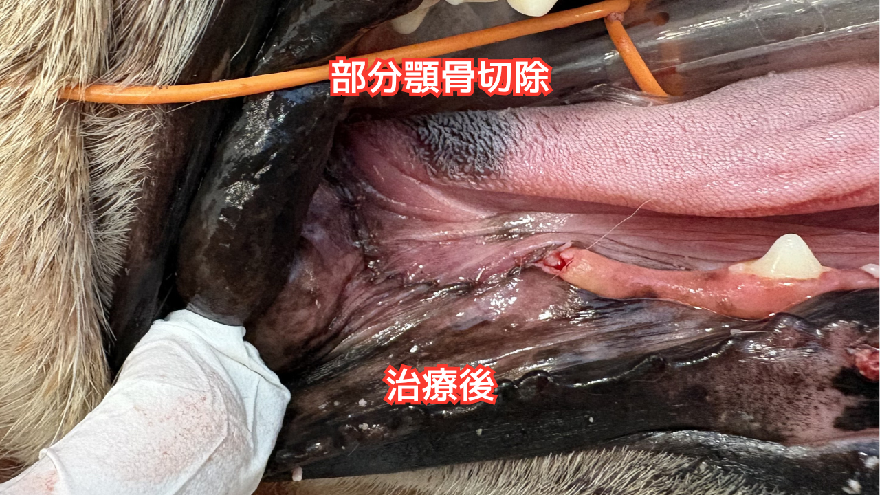 顎骨切除後の口腔写真