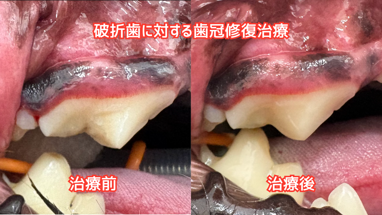 折れてしまった歯の治療前後の写真