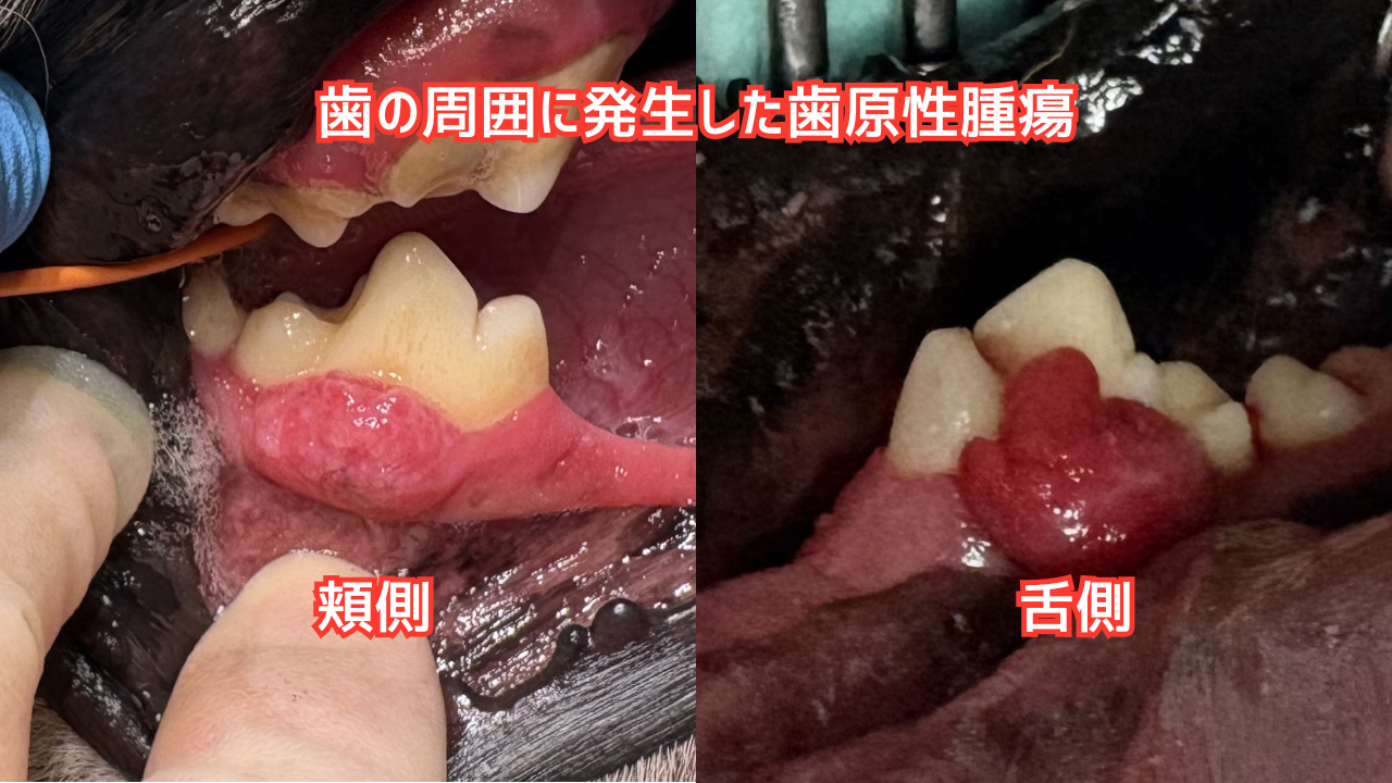 下顎第一後臼歯周囲にできた腫瘍