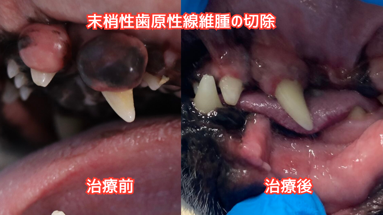 末梢性歯原性線維腫の治療ビフォーアフター