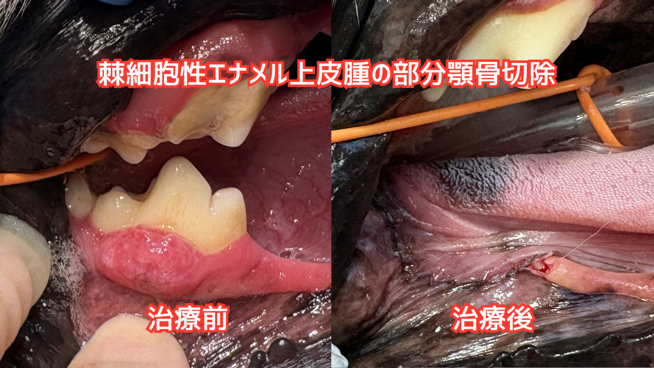 棘細胞性エナメル上皮腫の手術前、手術後の比較写真