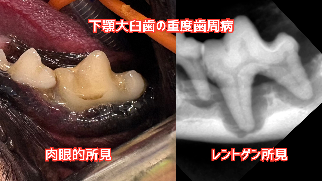 下顎大臼歯の症例写真、重度歯周病で骨が融解している。
