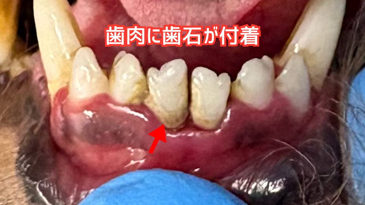 歯肉を覆ってしまう歯石