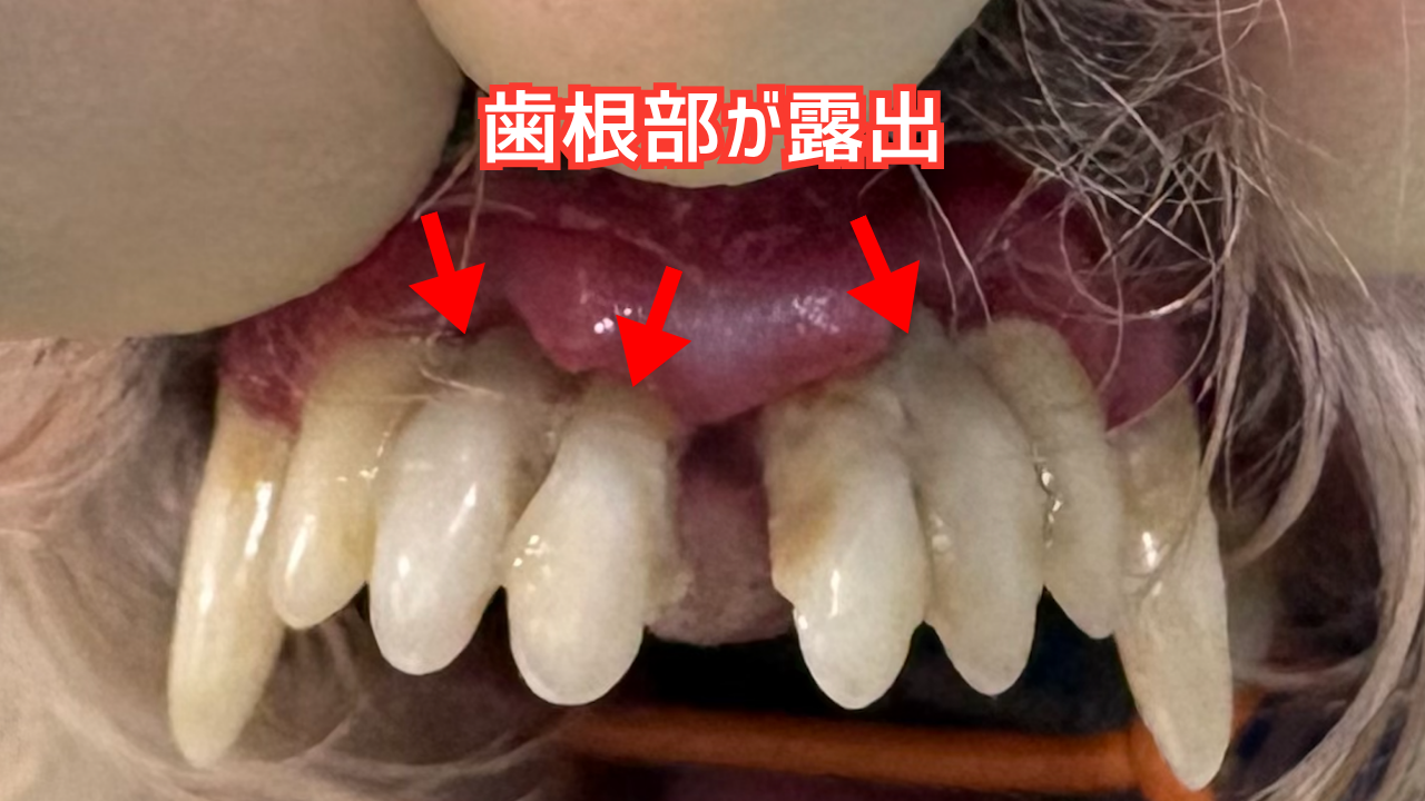 歯周病で歯肉が退縮し歯根が見えている