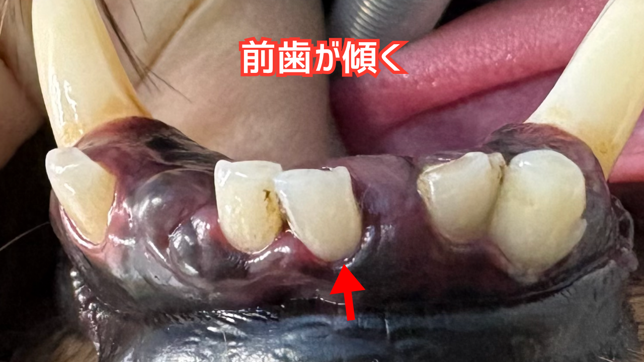 歯周病で傾いてしまった前歯
