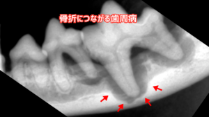骨折につながる重度の歯周病