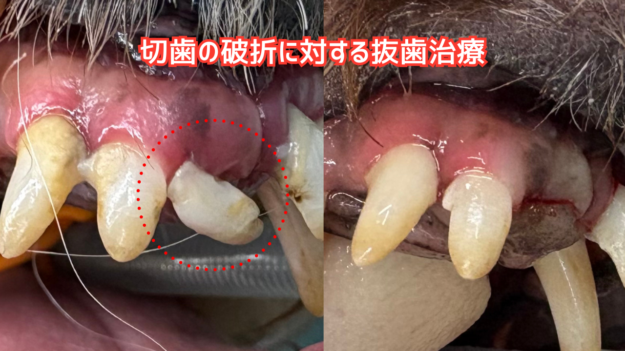 切歯の破折に対する残根の抜歯