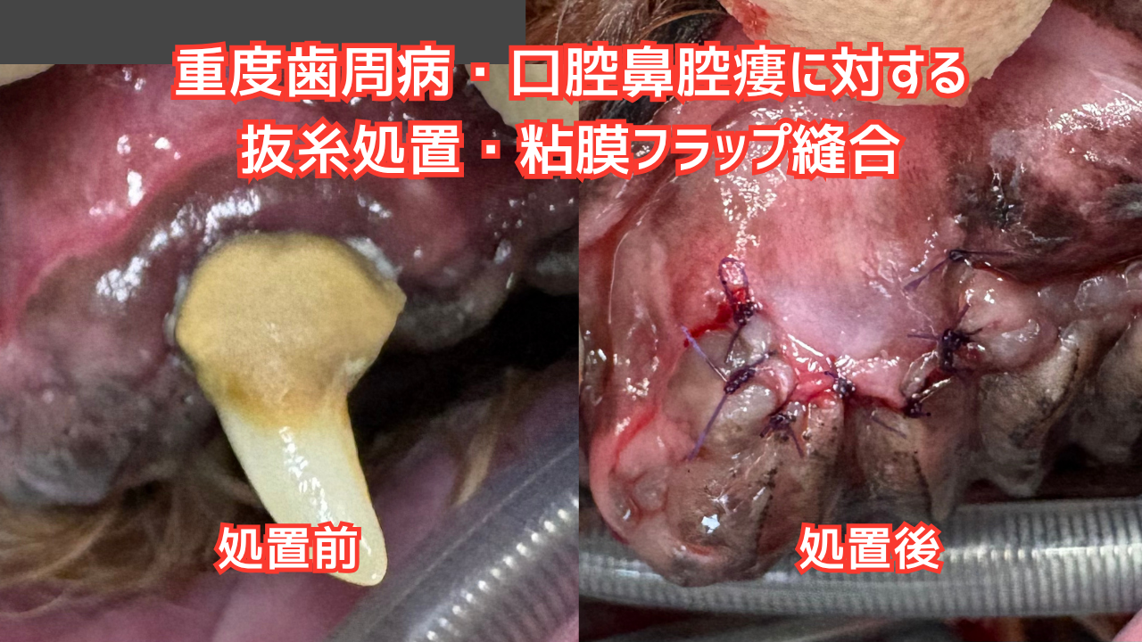口腔鼻腔瘻に対する抜歯処置、粘膜フラップ縫合
