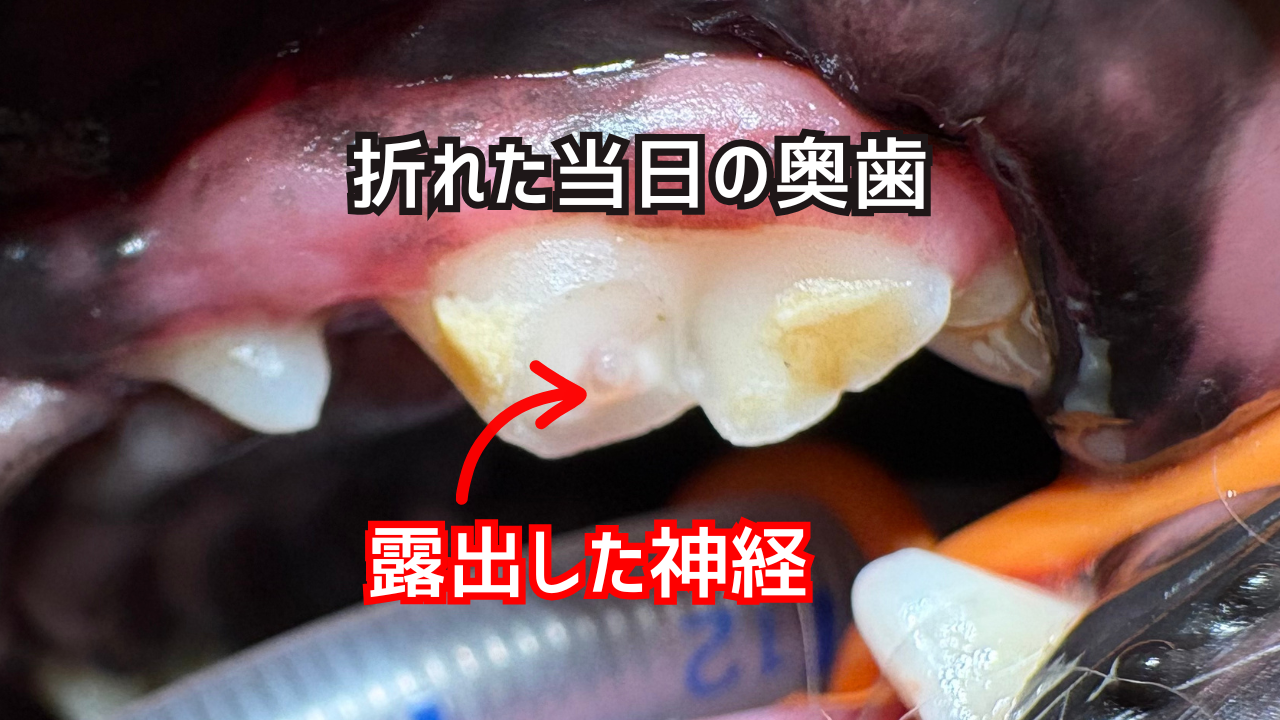 犬の歯が折れた当日の奥歯（左上顎第四前臼歯）と露出した神経
