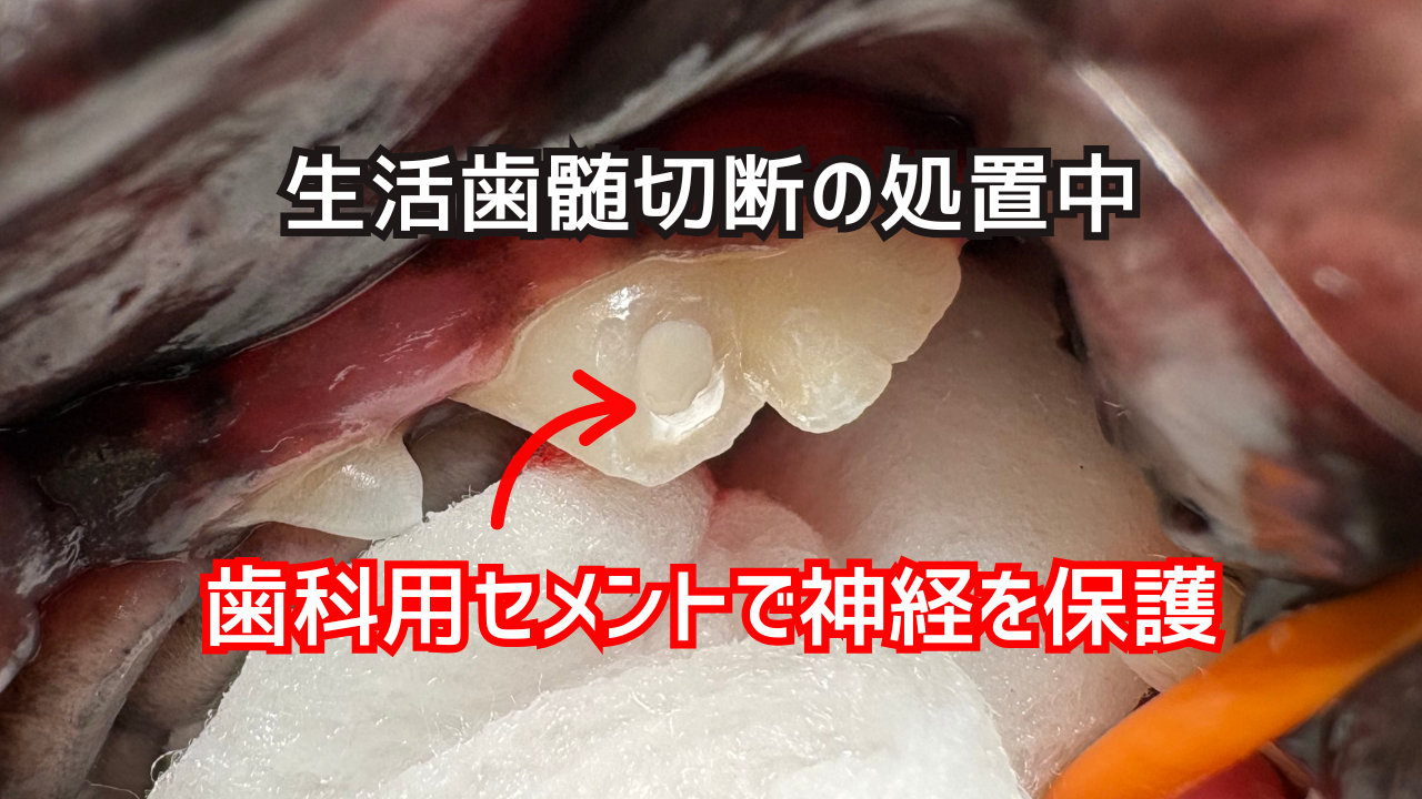 生活歯髄切断の治療中