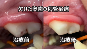 欠けた奥歯（左上顎第四前臼歯）の根管治療 治療前と治療後