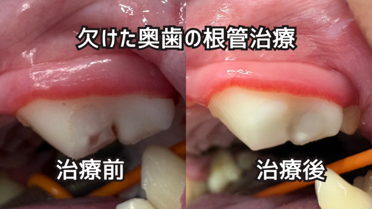 欠けた奥歯（左上顎第四前臼歯）の根管治療 治療前と治療後