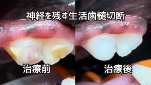犬の生活歯髄切断 治療前と治療後